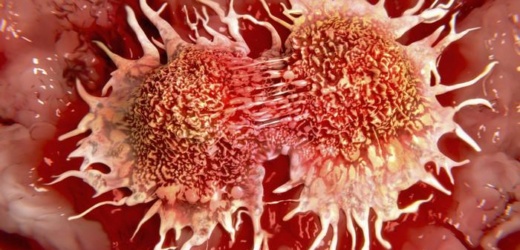 Estudio de fármaco contra el cáncer rectal concluye con la remisión de todos los pacientes