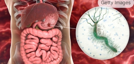 El Enemigo Invisible: El 70% de la población convive con la bacteria que detona el cáncer gástrico